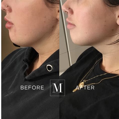 Belkyra to remove double chin .
